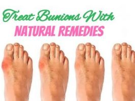 Powerful Natural Remedies With Treat Bunions