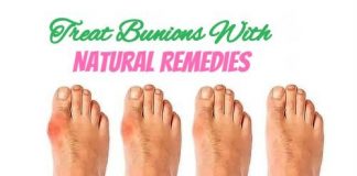 Powerful Natural Remedies With Treat Bunions