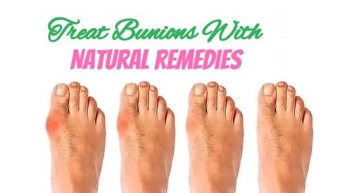 Treat Bunions With Some Powerful Natural Home Remedies