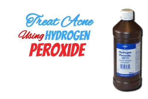 8 Super Ways of Treating Acne Using Hydrogen Peroxide